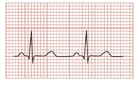 Normal rhythm of ECG signal, reproduced under Creative... | Download ...