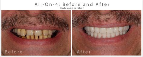 All on 4 Dental Implants Before & After Seattle | Shor Dental