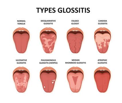 "Tongue Disease" Images – Browse 35 Stock Photos, Vectors, and Video ...