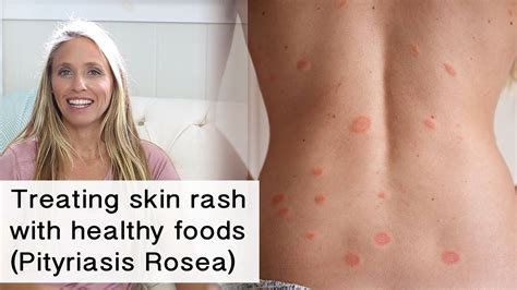 Treating skin rash and inflammation with healthy foods (Pityriasis ...