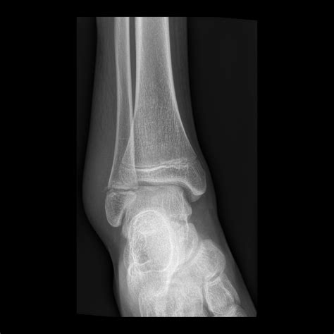 Salter-Harris Fracture | Pediatric Radiology Reference Article ...