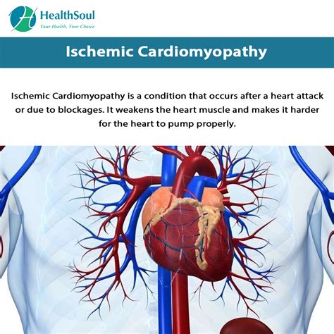 Ischemic Cardiomyopathy – Healthsoul