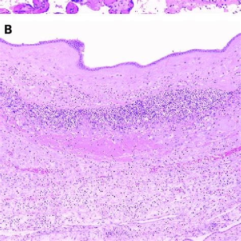 Chronic deciduitis, isolated to the decidua basalis. The decidua shows... | Download Scientific ...