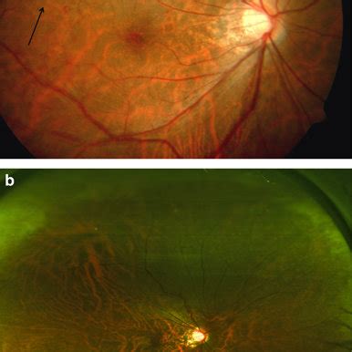 Colour fundus photograph of the right eye demonstrating features of... | Download Scientific Diagram