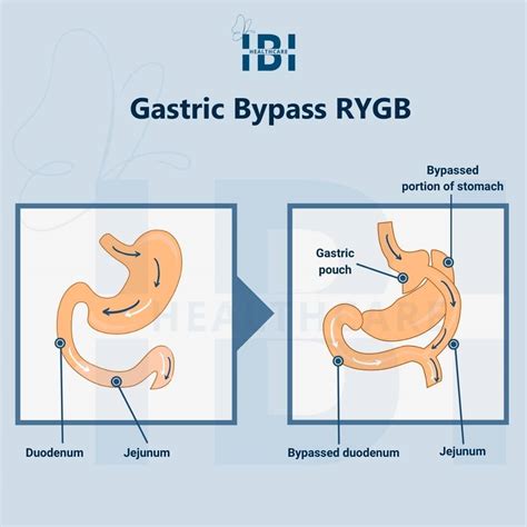 Long-Term Diet After Gastric Bypass Surgery