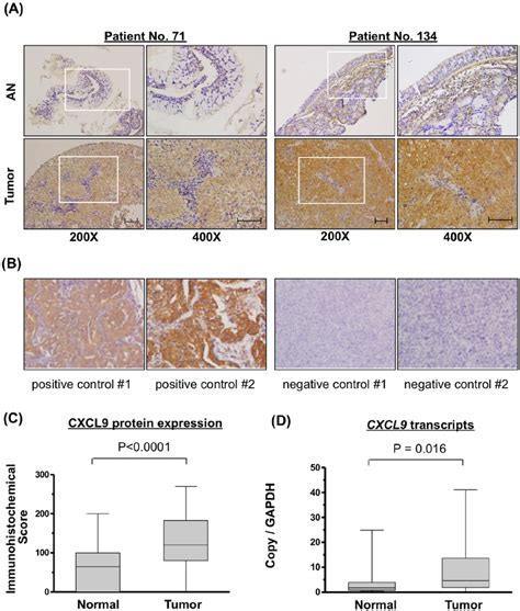 Overexpression of CXCL9 in NPC tissues. (A) Immunohistochemical... | Download Scientific Diagram