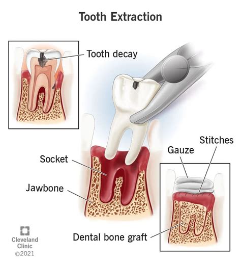 Tooth Extraction: Procedure, Aftercare & Recovery (2023)