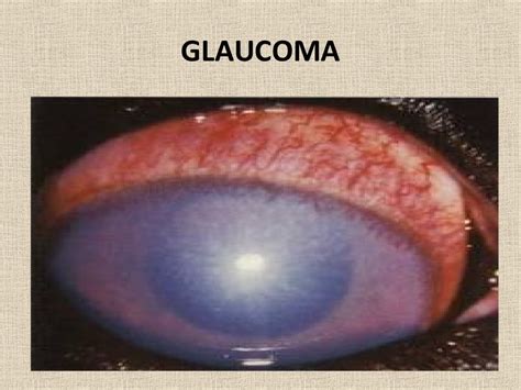 Corneal edema