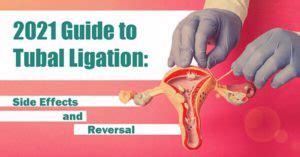 Tubal Ligation: What It Is, Side Effects, Reversal, and Risks