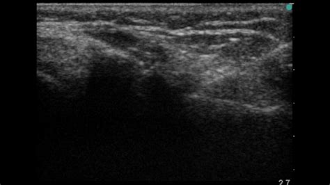 Hematoma Block - Internet Book Of MSK Ultrasound