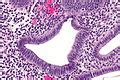 Disordered proliferative endometrium - Libre Pathology