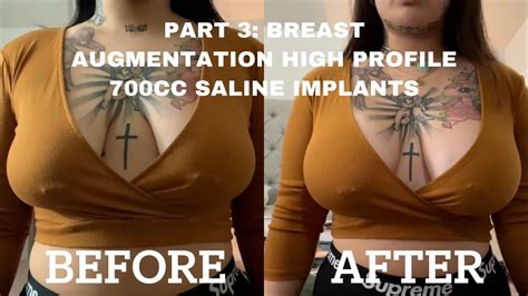 PART 3: BREAST AUGMENTATION VLOG (700CC HIGH PROFILE SALINE IMPLANTS ...