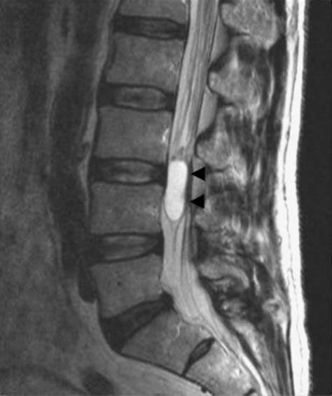 Preoperative sagittal T2-weighted MRI scan of the lumba | Open-i