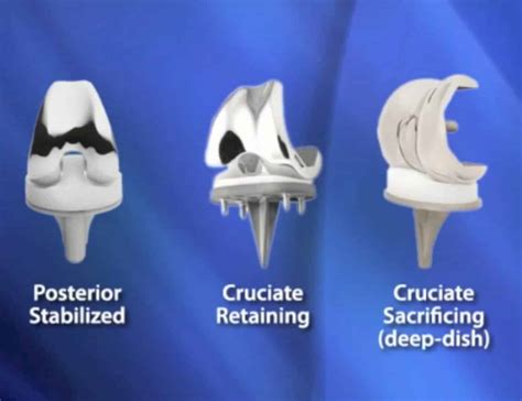 Knee Joint Replacement Devices