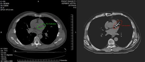 LCHF 15 years, Coronary Artery Calcium Score ZERO! - Jeffry Gerber, MD - Denver's Diet Doctor