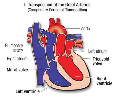 l-Transposition of the Great Arteries | American Heart Association