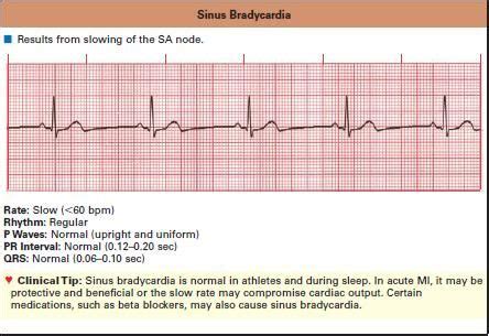 Sinus Bradycardia in ECG | eNurse CarePlan | Sinusitis, Cardiac nursing ...