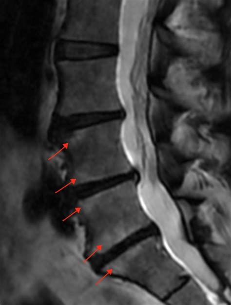 Intracept Procedure - Rockville, MD & Frederick, MD: Pain Management Specialists: Board ...