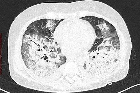 CT Useless for COVID-19 Diagnosis, Study Affirms | MedPage Today