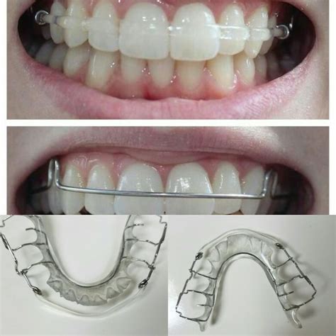 Clear retainer | Brackets dentales, Aparatos de ortodoncia, Ortodoncia