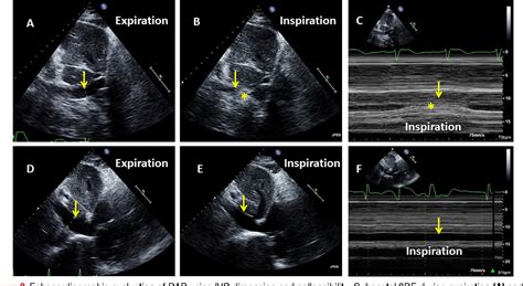 Table 2 from Noninvasive evaluation of right atrial pressure ...