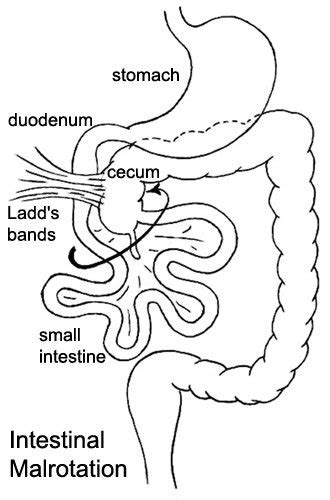 Volvulus Malrotation