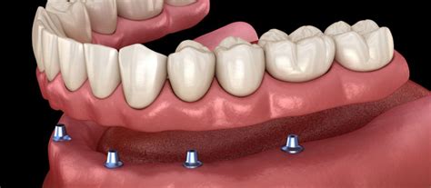 Need Additional Care Before Your Implant Supported Dentures Are Placed? We Can Help You With ...