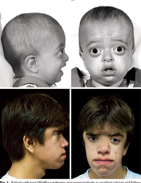 Figure 3 from Pfeiffer syndrome: a treatment evaluation. | Semantic Scholar