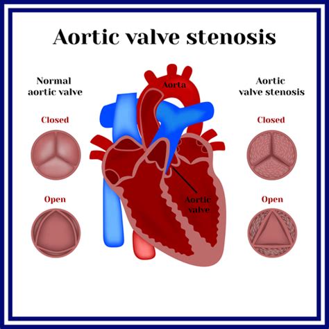 Aortic Stenosis: Causes, Symptoms and Treatment | Cardiology | HealthSoul