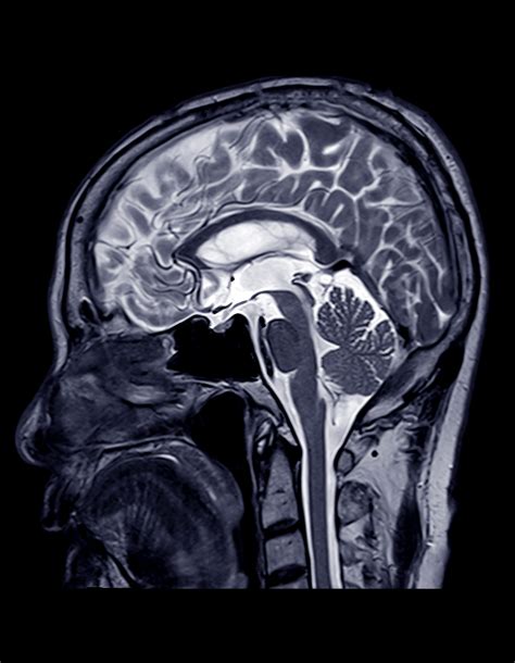 Stenoze carotidiene - Afectiuni si conditii - clinica Neuroaxis