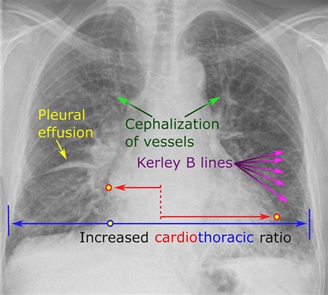 Chest X-ray of congestive heart failure [14] | Download Scientific Diagram