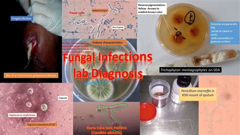 Fungal Infections Laboratory diagnosis: Introduction, sample collections