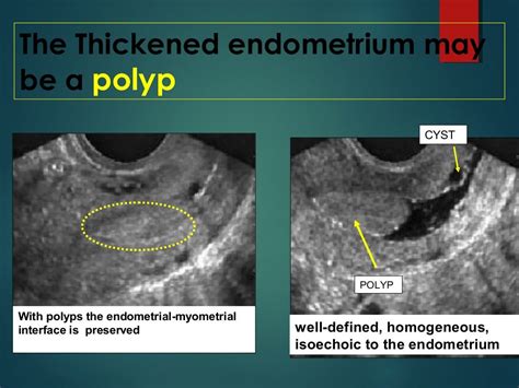 Sonohysterography