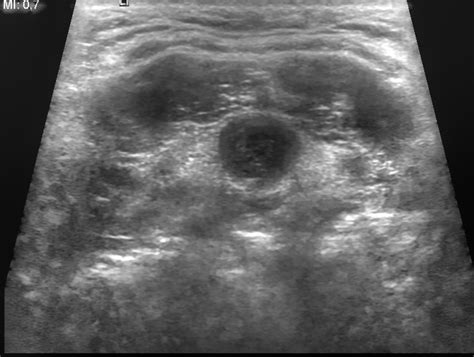 Branchial Cleft Cyst Ultrasound