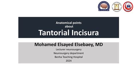 anatomical points about tentorial incisura | PPT