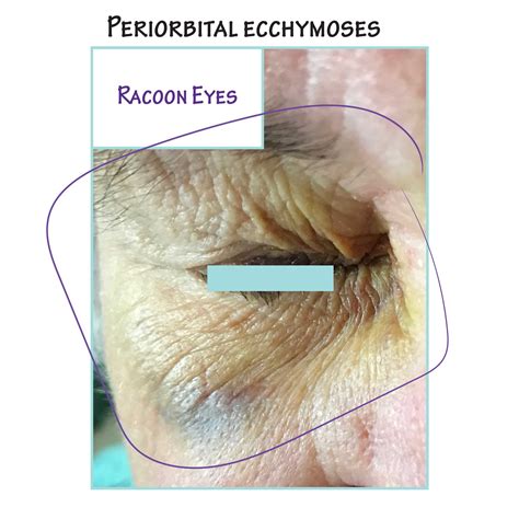 Pathology Glossary: Raccoon Eyes | Draw It to Know It