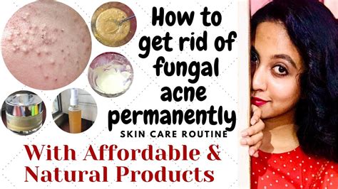 FUNGAL ACNE TREATMENT WITH AFFORDABLE AND HOMEMADE PRODUCTS | HOW TO ...