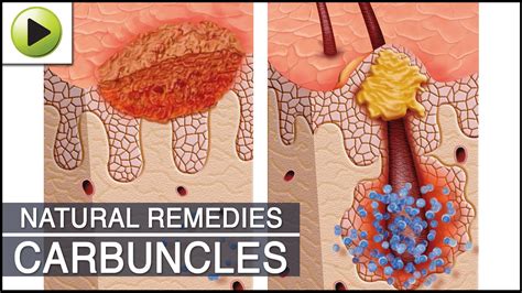 Home Remedies for Carbuncles - CookeryShow.com