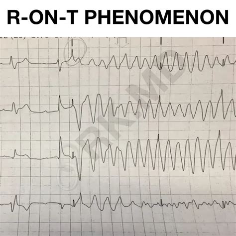 R-on-T Phenomenon | RK.MD