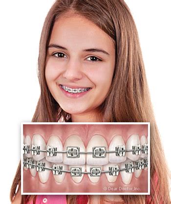 Metal Braces Colors