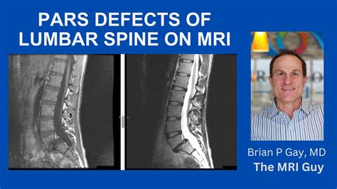 Pars defect on MRI - YouTube