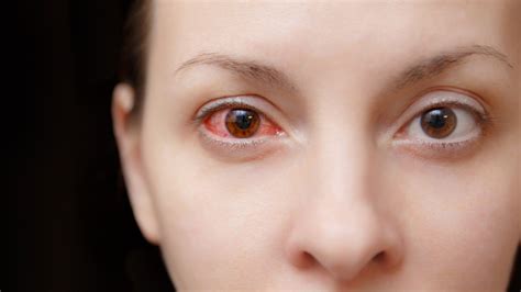 What Causes Pink Eye, and How Do You Get Rid of It? | Allure