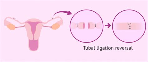 Tubal ligation reversal