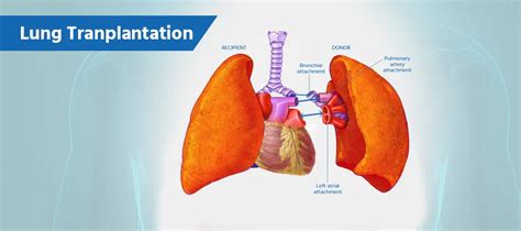 Lung Transplant Cost in India - Get Price Estimate