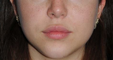 Lip Augmentation Fat Transfer - Liposuction UK