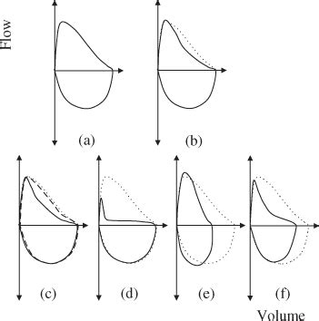 Spirometry | Thoracic Key