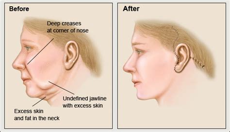 Face and Neck Lift - Cosmetic Plastic Surgery, Dr Benjamin Norris