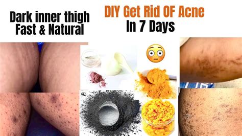 HOW TO GET RID OF DARK INNER THIGH & B*TT ACNE FAST & NATURAL ( DIY ...