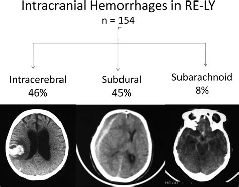 Intracranial Hemorrhage - Cause, Symptoms, Diagnosis, Treatment