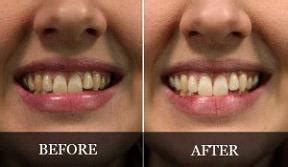 Oil Pulling Before and After (with Pictures) | New Health Advisor